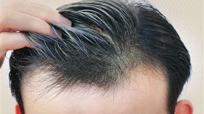 استشاري يوضح كيفية زراعة الشعر بتقنية 