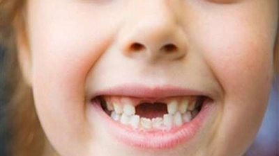 5 مخاطر من تسوس الأسنان اللبنية للأطفال وخلعها مبكرًا