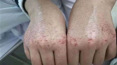 بعد تداول صورتها.. هل يخترق فيروس كورونا القفازات الطبية؟