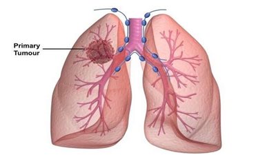 بمناسبة يومه العالمي.. الوكالة الدولية لبحوث السرطان تنشر تقريرًا عن أنواعه
