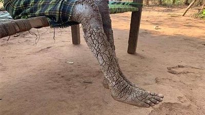 ليس له تفسير.. مرض نادر يحير أطباء العالم