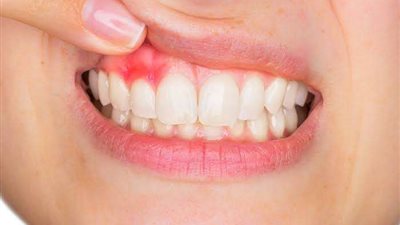 أحذري..  هذا المرض يسبب  ظهور شعر بالذقن والشارب واللثة للفتاة