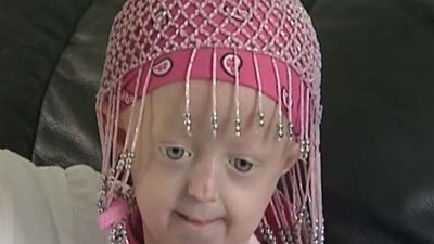 بعد إصابة 350 .. الشيخوخة المبكرة تنهي حياة طفلة أوكرانية