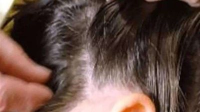 عاجل| التعليم تُصدر قرارًا بشأن هجوم القمل على الطالبات