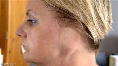 بسبب هذه العادة.. سيدة تفقد أذنها اليسرى