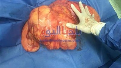 فريق طبى ينجح فى استئصال ورم سرطانى لمسنه عمرها 67 عامًا بالمنوفية