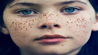 اعتقدت أنها نمش.. علامات على جسد امرأة تكشف إصابتها بالسرطان