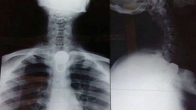 كاد أن يفقد حياته.. عشريني يبتلع 