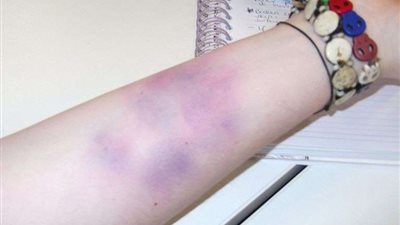 إحذر.. البقع الزرقاء بالجسد تنذر بالسرطان