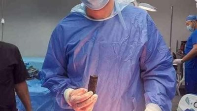 كلاكيت تاني مرة بمستشفى بنها الجامعي.. استخراج هاتف محمول من معدة شاب ( صور)
