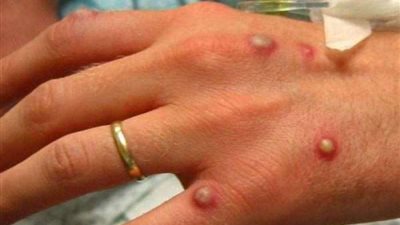 موديرنا تختبر لقاحا للوقاية من جدري القرود