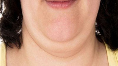 استشاري أمراض جلدية تكشف طريق التخلص من الذقن المزدوج 