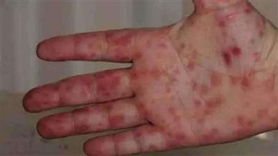 أنفلونزا الطماطم .. ظهور فيروس جديد يصيب الكبار والصغار