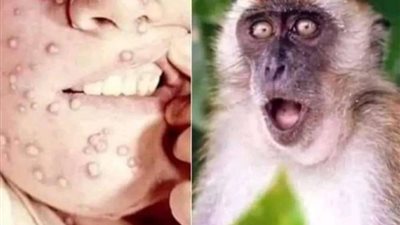 طبيب مناعة يكشف طرق انتقال جدرى القرود