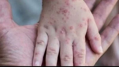 الصحة.. جدري القرود لم يصل مصر حتى الأن