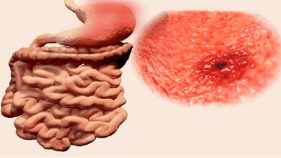 من خلال البراز..