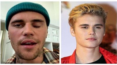 متلازمة رامزي هانت.. جاستن بيبر يعلن إصابته بشلل في وجهه (فيديو)