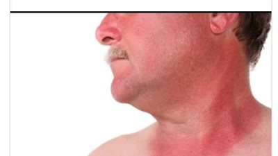 كل ما تريد معرفته عن وباء العراق الجديد.. 