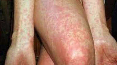 أخطر من الكورونا.. سلالة جديدة من الحمى القرمزية تظهر في بريطانيا