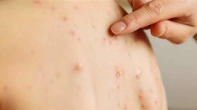 روسيا تسجل أول حالة إصابة بفيروي جدري القرود