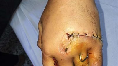 إعادة توصيل كف يد بعد بترها بمستشفى طوارئ المنصورة