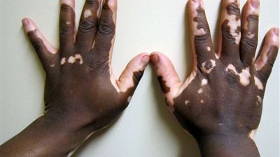 الغذاء والدواء الأمريكية توافق على أول علاج موضعى لمرض البهاق