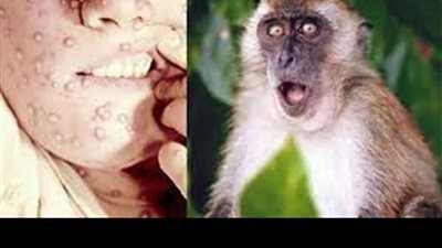 العالم يترقب قرار من الصحة العالمية بشأن جدري القردة