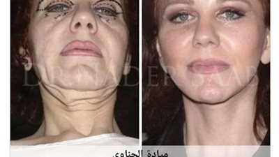 عملية تجميل تغير شكل ميادة الحناوي.. طبيب يكشف التفاصيل