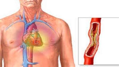 وليد الدالي يحذر من إهمال علاج الشرايين الطرفية .. قد تسبب البتر