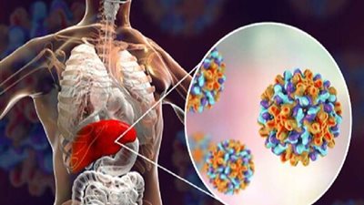 في اليوم العالمي لالتهاب الكبد.. 7 نصائح لتجنب الإصابة به