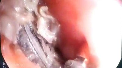 أطباء جامعة المنصورة ينجحون في استخراج معدن عالق في مريئ طفلة