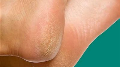 التخلص من تشقق الأقدام نهائيا