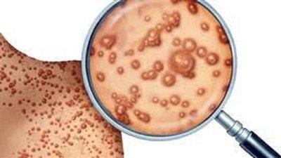 العالم على أعتاب كارثة صحية جديدة و السبب جدري القرود .. تفاصيل