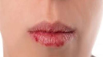 لعلاج الشفاه والحروق الشمسية.. وصفات منزلية لتخفيف الألم