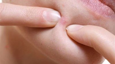 ظهور حب الشباب في منطقة الذقن.. إعرفي الأسباب وطرق العلاج