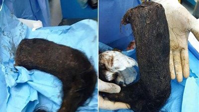 شاهد .. لحظة إخراج الأطباء لـ2 كيلو شعر من داخل بطن فتاة