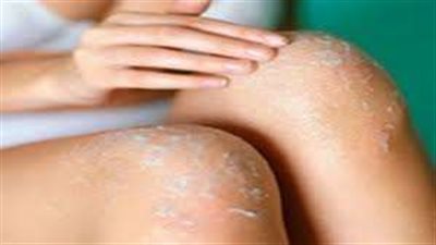 طرق للتخلص من اسمرار  المناطق الحساسة