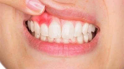 التهابات اللثة وسر ارتباطها بأمراض القلب.. مفاجأة صادمة