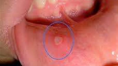 آفات الفم.. الأسباب والعلاج