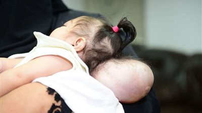 جامعة سوهاج تستجيب لعلاج طفلة مصابة بمرض  نادر بالجمجمة