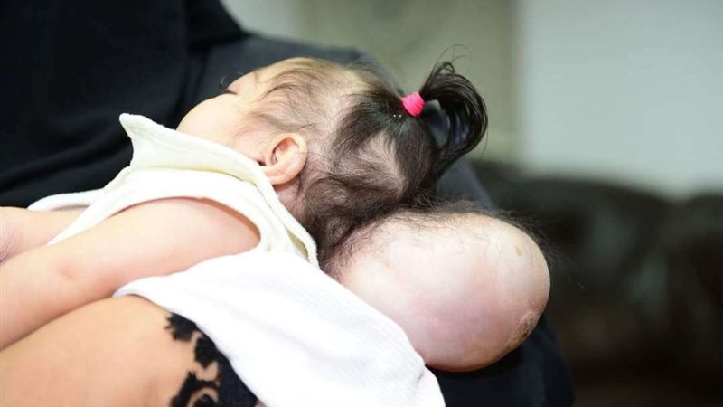 مرض نادر بالجمجمة