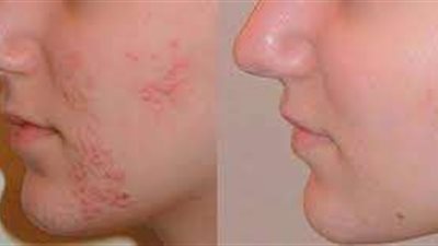 وصفة طبيعية لعلاج حب الشباب للبشرة الدهنية