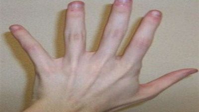 دراسة غريبة.. أصحاب الأصابع الطويلة الأقل عرضة للإصابة بـ فيروس كورونا