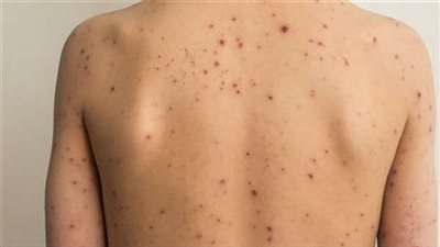 وزارة الصحة الأردنية تعلن عن تسجيل أول إصابة بمرض جدري القرود