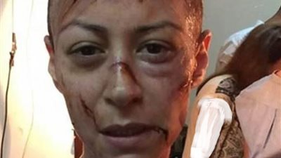 بشعر أصلع وكدمات تملأ الوجه.. هكذا أفزعت منه شلبي جمهورها