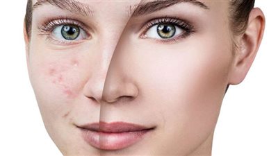 أسباب ظهور حب الشباب وعلاقتها بالتغيرات الهرمونية