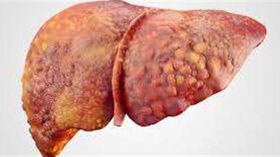 تعرف على أسباب وأعراض مرض تليف الكبد