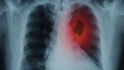 دراسة: قد تصاب بسرطان الرئة حتى لو لم تدخن | تفاصيل
