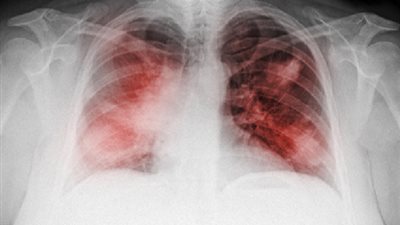 صدمة.. تعرف على علامات السرطان التي تنسب لأعراض فيروس كورونا