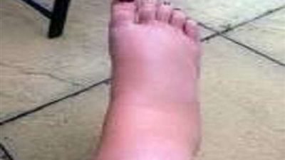 احذر تورم القدم اليمني قد يؤدي بك إلى الوفاة